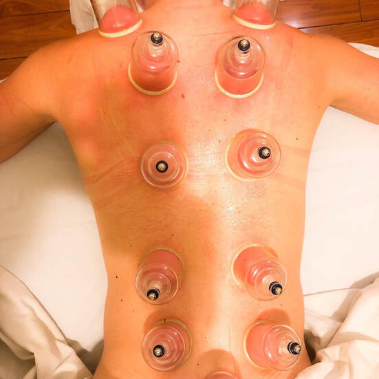 Cupping Therapy San Diego Coronado - Yoga Fits Me, Online Yoga Workouts, Online Yoga Classes
